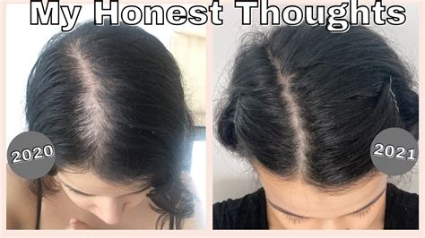does minoxidil work for hereditary hair loss