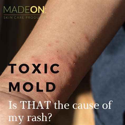 Does Mold Cause Ra