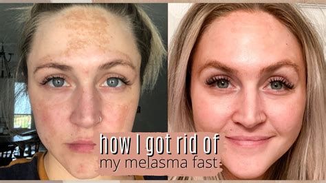 Does Musely Work On Melasma