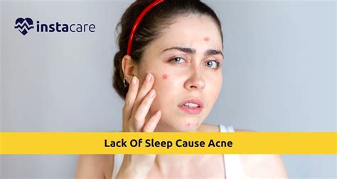 Does Not Sleeping Cause Acne