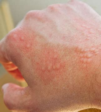 Does Oats Cause Allergy