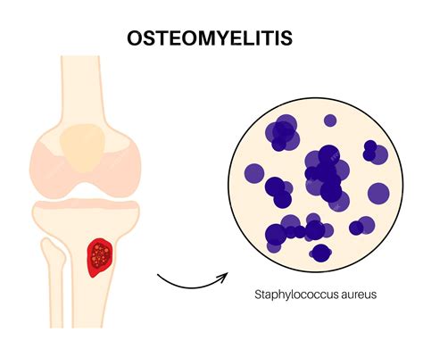 Does Osteomyelitis Cause Permanent Damage