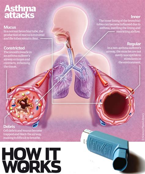 Does Oxygen Help Asthma