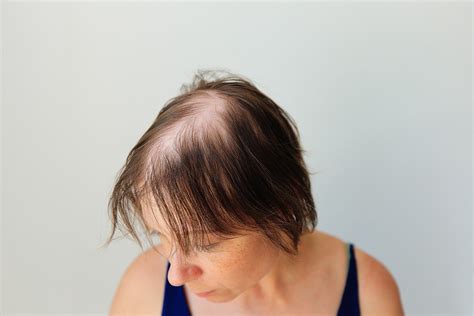 does ozempic cause hair thinning