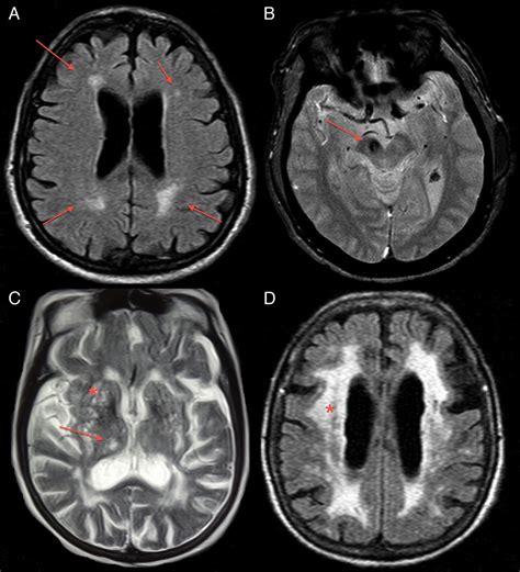 does parkinson's disease show up on an mri