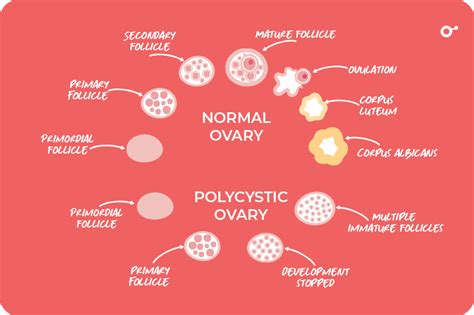 Does Pcos Affect Ovulation Tests