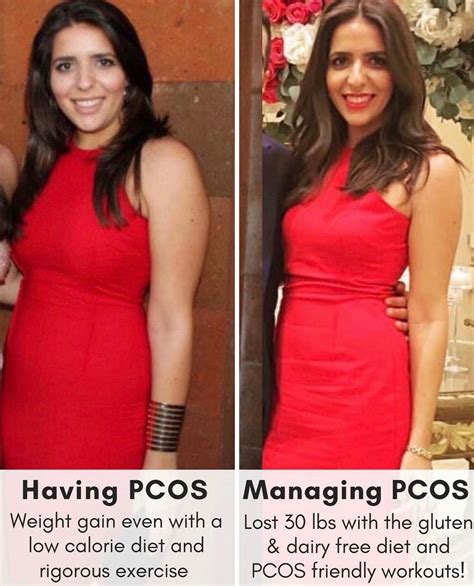 Does Pcos Cause Weight Loss