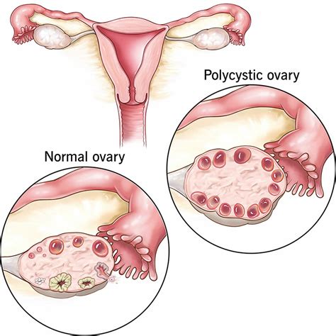 Does Pcos Have Cure