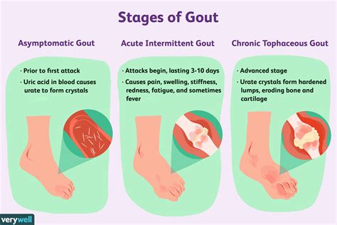 Does Peanuts Trigger Gout