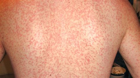 does penicillin cause rash with mono