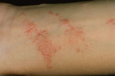 Does Poison Ivy Spread: Separating Fact from Itchy Fears