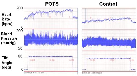 Does Pots Increase Heart Rate
