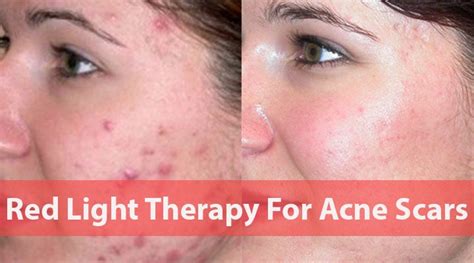 Does Red Light Therapy Help Acne Scars
