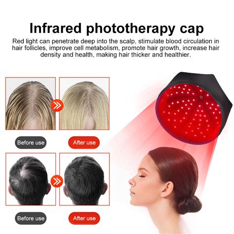 Does Red Light Therapy Help Alopecia