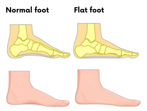 Does Running Cause Flat Feet