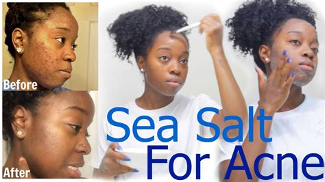 Does Salt Water Help with Acne? Discover the Truth and Transform Your Skin!