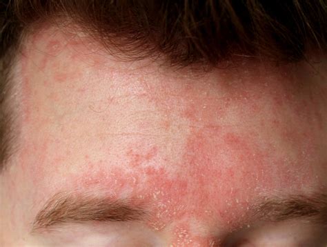 does seborrheic dermatitis cause rash