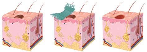 Does Shave Excision Leave A Scar