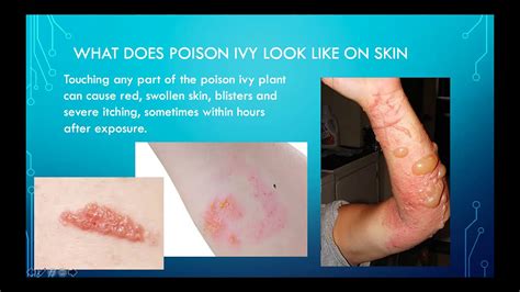 Does Showering Help With Poison Ivy