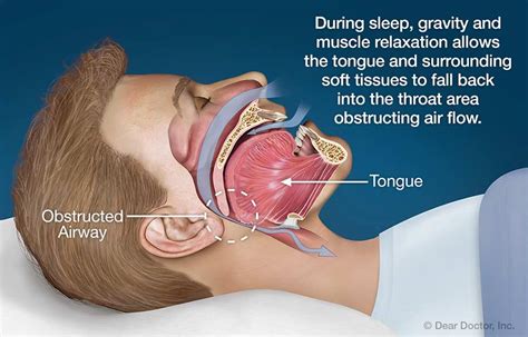 Does Sleeping With Earplugs Cause Snoring