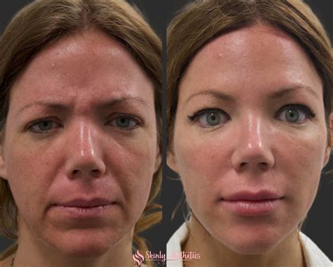 does smile line filler hurt