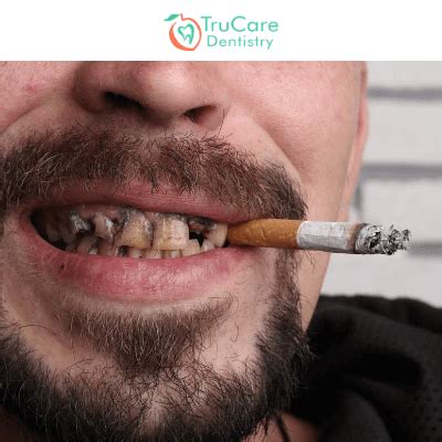 Does Smoking Affect Tooth Filling