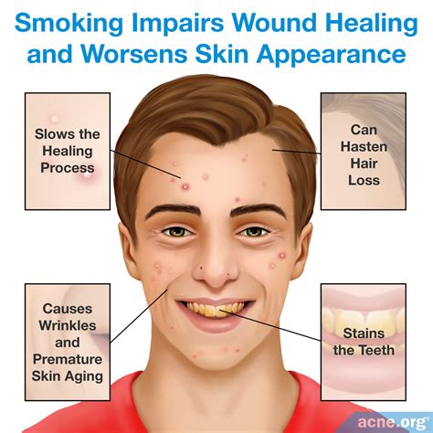 Does Smoking Cause Acne? Unraveling the Connection