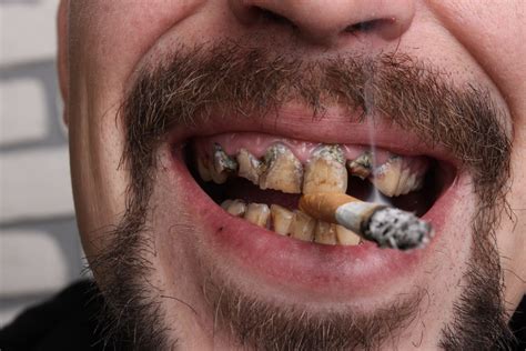 Does Smoking Cause Bad Teeth