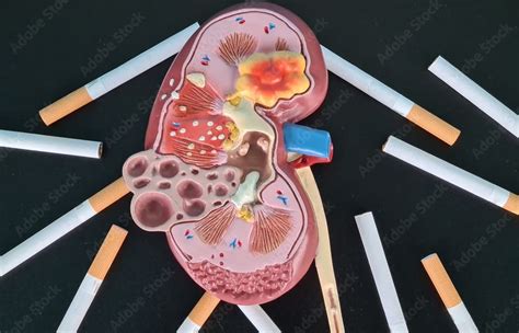 Does Smoking Harm Kidneys