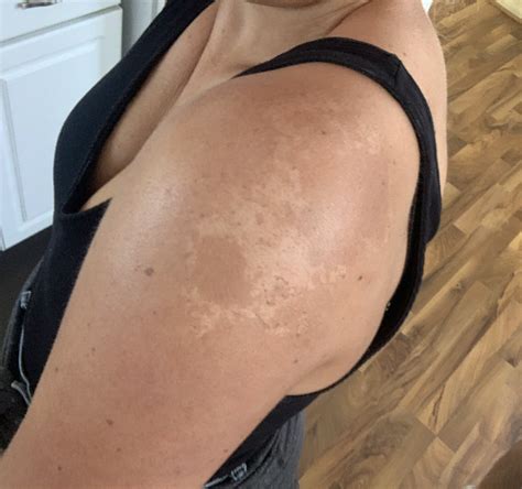 Does Spray Tan Stop Sunburn