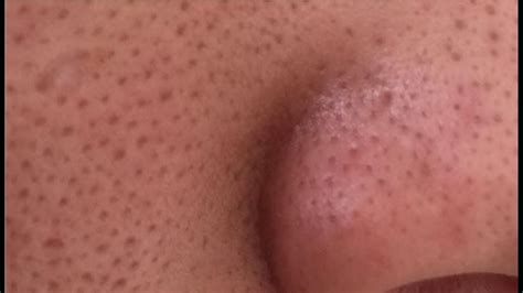 Does Steam Actually Open Pores