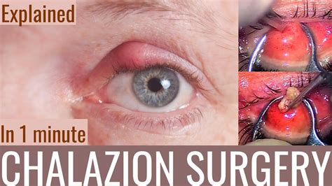 Does Steam Help Chalazion