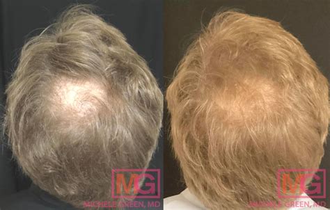 does stress cause bald spots