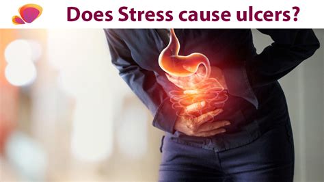 Does Stress Cause Ulcers