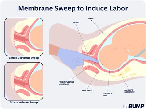 Does Stripping Membranes Work At 38 Weeks