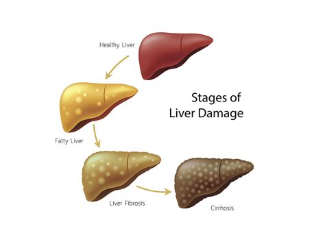 Does Sugar Cause Liver Damage