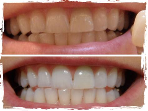 Does Sunbeds Whiten Your Teeth