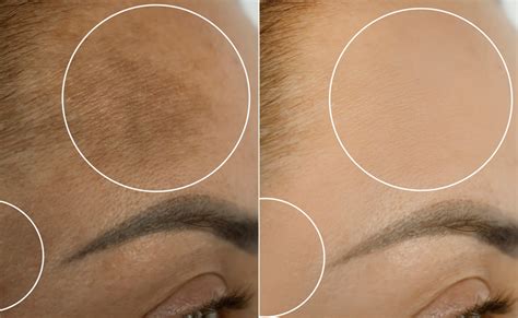 Does Tanning Get Rid Of Dark Spots