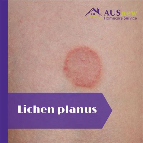 Does Tanning Help Lichen Planus