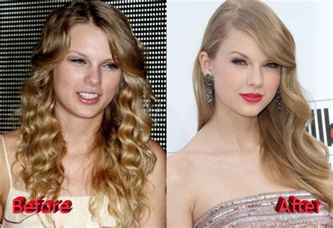 does taylor swift have plastic surgery
