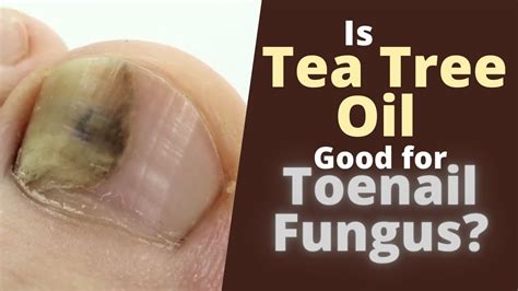 Does Tea Tree Kill Fungus
