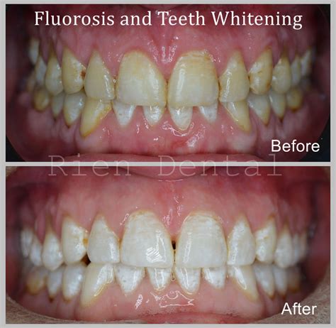 Does Teeth Whitening Help Fluorosis