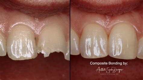 Does Teeth Whitening Work On Composite Veneers