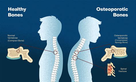 Does Testosterone Cause Osteoporosis