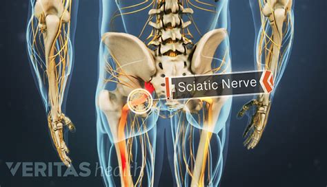does the mckenzie method work for sciatica