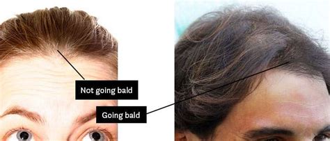  79 Ideas Does Thin Hair Mean Your Going Bald For Long Hair