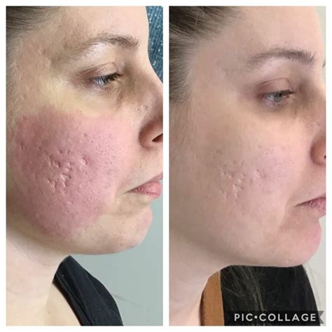 Does Threading Cause Scarring