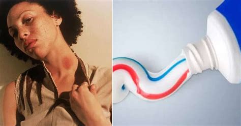 Does Toothpaste Remove Hickey