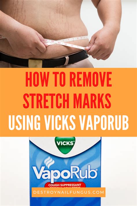 Does Vaporub Remove Stretch Marks