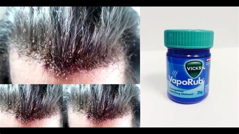 Does Vicks Remove Hair